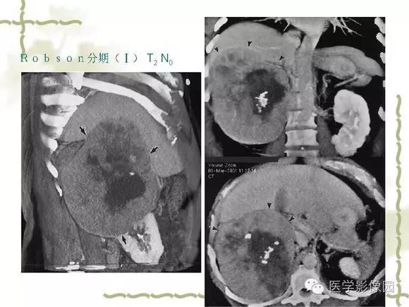 【PPT】肾癌的影像学表现