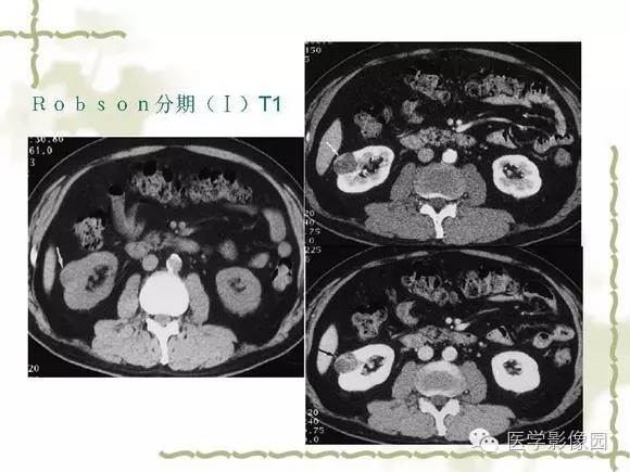 【PPT】肾癌的影像学表现