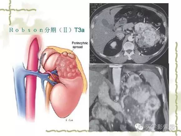 【PPT】肾癌的影像学表现