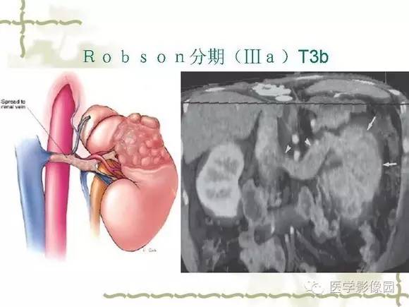 【PPT】肾癌的影像学表现