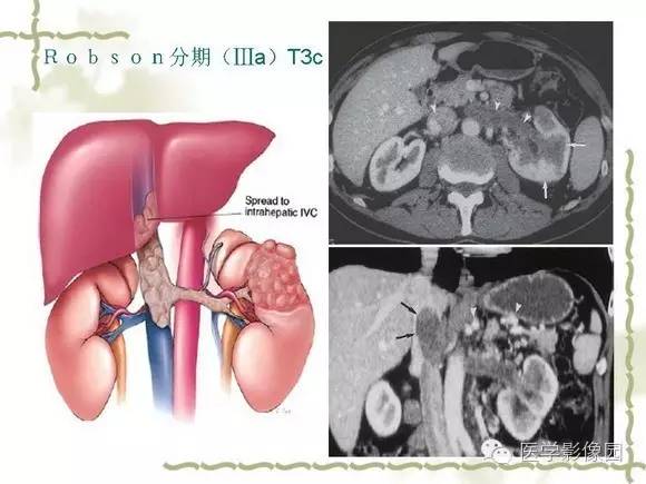 【PPT】肾癌的影像学表现