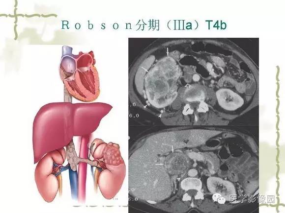 【PPT】肾癌的影像学表现