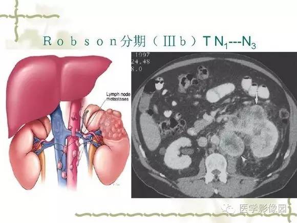 【PPT】肾癌的影像学表现