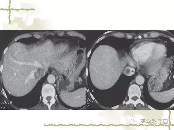 【PPT】肾癌的影像学表现