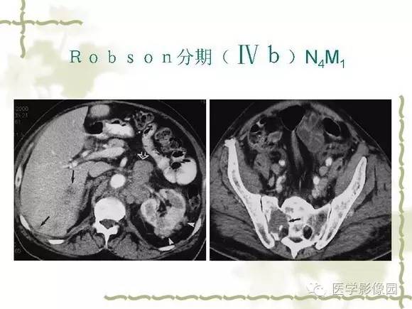 【PPT】肾癌的影像学表现
