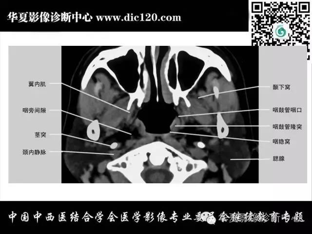【PPT】鼻咽部疾病影像诊断与鉴别