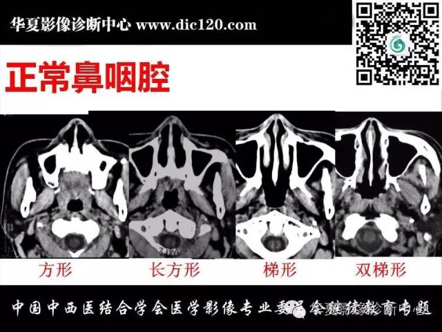 【PPT】鼻咽部疾病影像诊断与鉴别