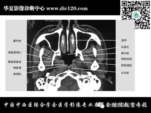 【PPT】鼻咽部疾病影像诊断与鉴别