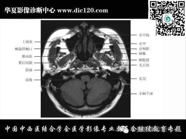 【PPT】鼻咽部疾病影像诊断与鉴别
