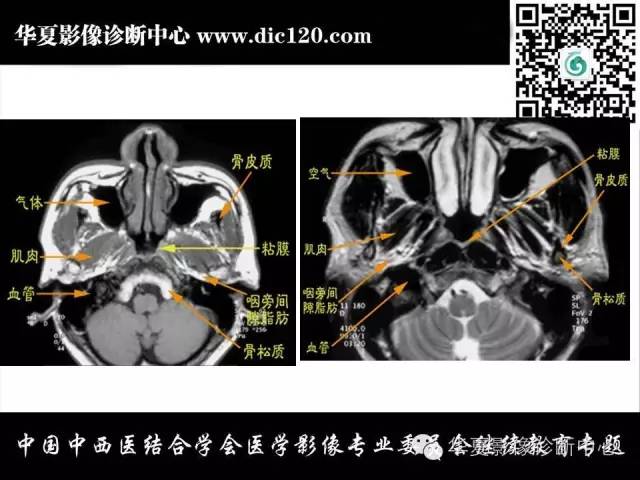 【PPT】鼻咽部疾病影像诊断与鉴别