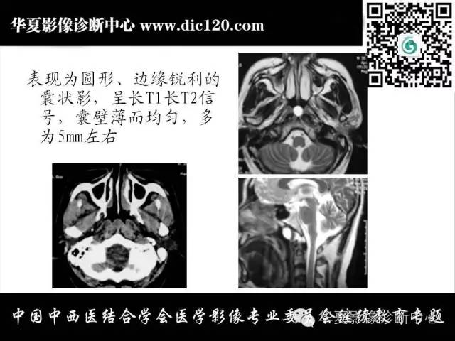 【PPT】鼻咽部疾病影像诊断与鉴别