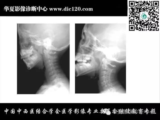 【PPT】鼻咽部疾病影像诊断与鉴别