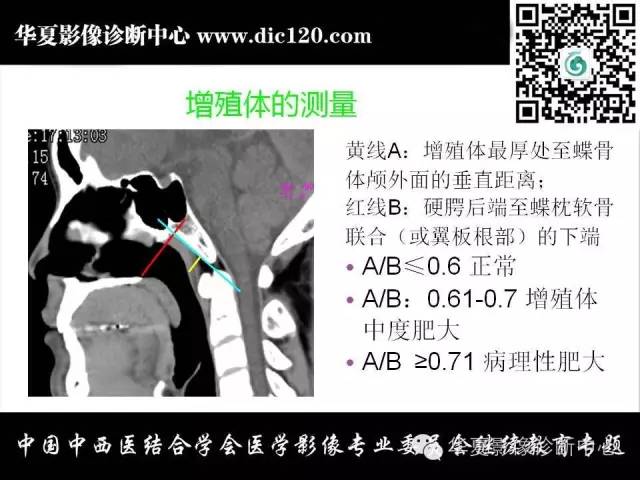 【PPT】鼻咽部疾病影像诊断与鉴别