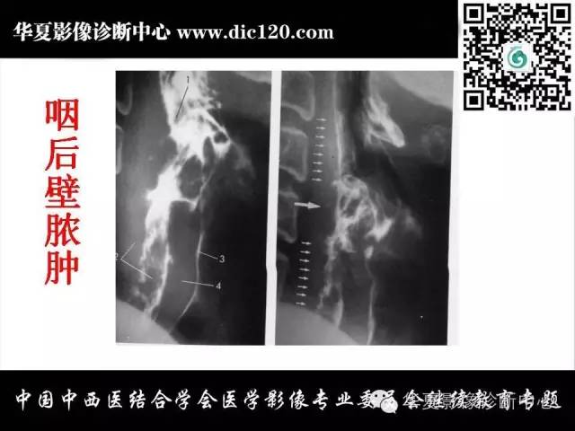 【PPT】鼻咽部疾病影像诊断与鉴别
