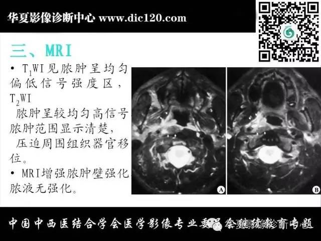 【PPT】鼻咽部疾病影像诊断与鉴别