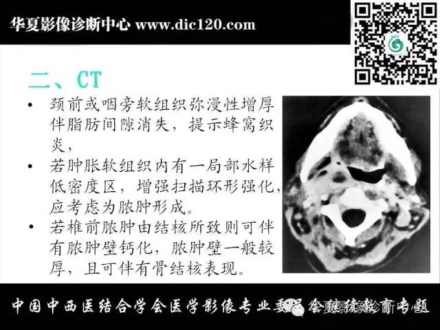 【PPT】鼻咽部疾病影像诊断与鉴别