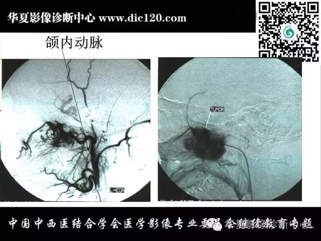 【PPT】鼻咽部疾病影像诊断与鉴别