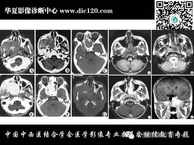 【PPT】鼻咽部疾病影像诊断与鉴别