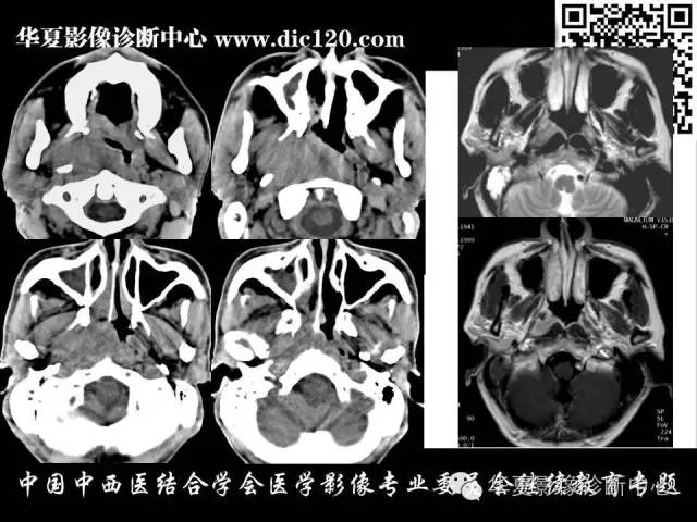 【PPT】鼻咽部疾病影像诊断与鉴别