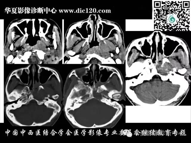 【PPT】鼻咽部疾病影像诊断与鉴别