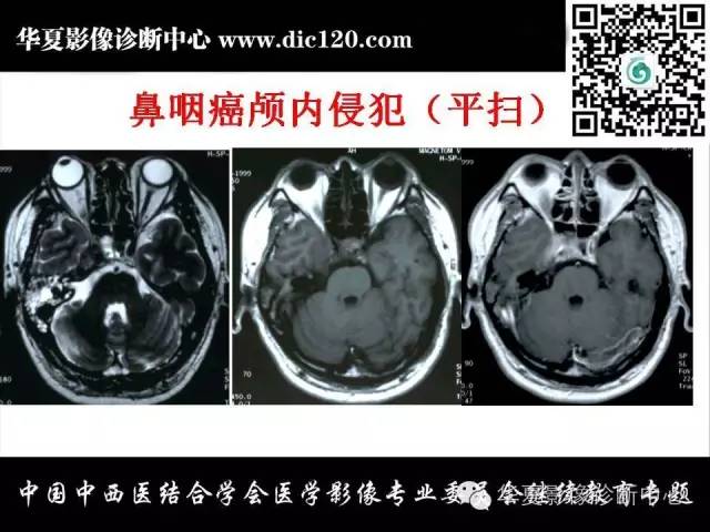 【PPT】鼻咽部疾病影像诊断与鉴别