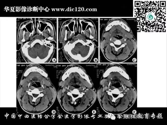 【PPT】鼻咽部疾病影像诊断与鉴别