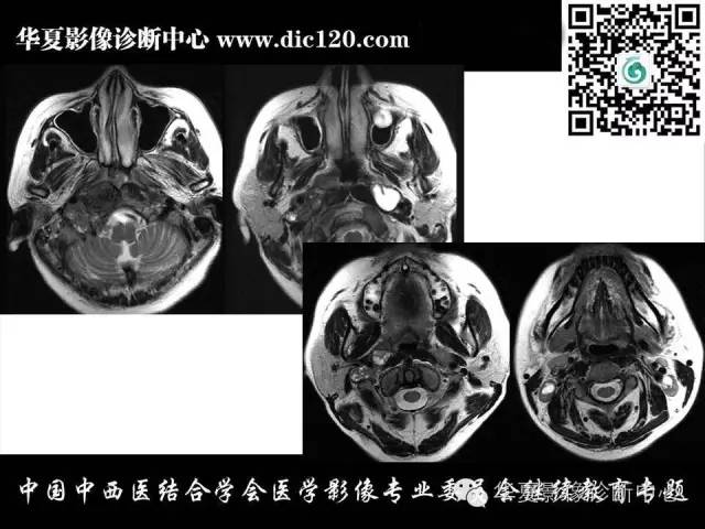 【PPT】鼻咽部疾病影像诊断与鉴别