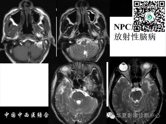 【PPT】鼻咽部疾病影像诊断与鉴别