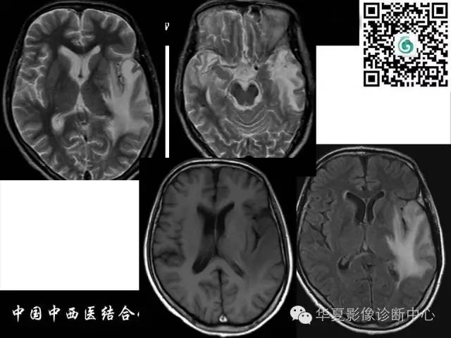 【PPT】鼻咽部疾病影像诊断与鉴别