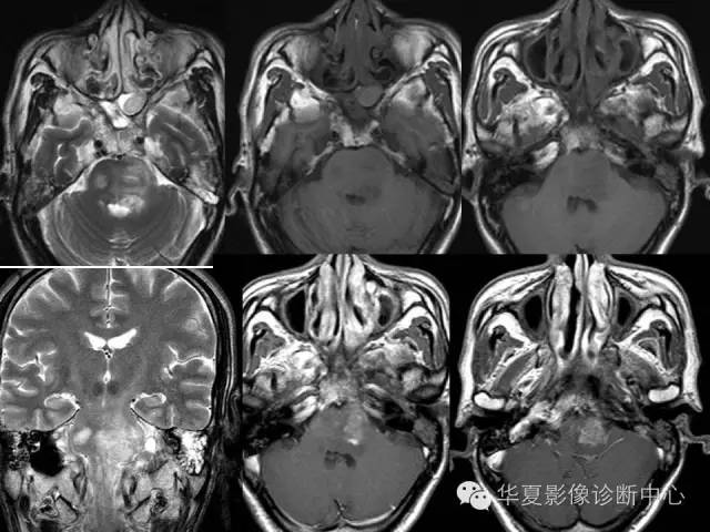 【PPT】鼻咽部疾病影像诊断与鉴别