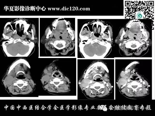 【PPT】鼻咽部疾病影像诊断与鉴别