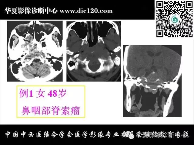 【PPT】鼻咽部疾病影像诊断与鉴别