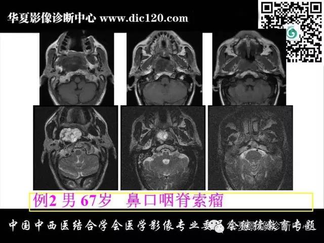 【PPT】鼻咽部疾病影像诊断与鉴别