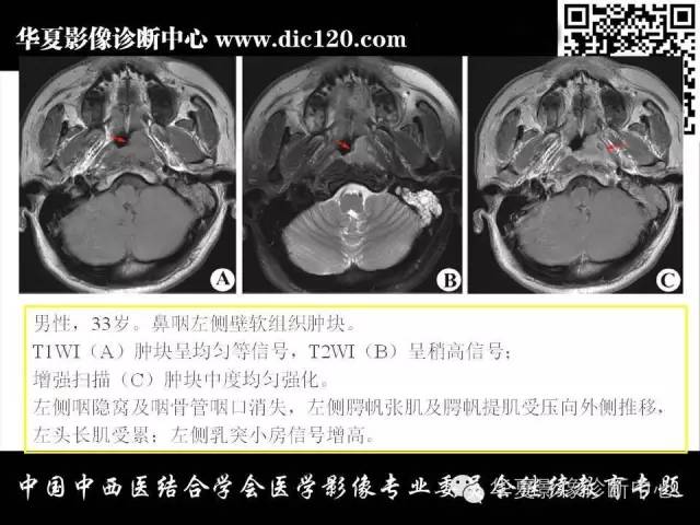 【PPT】鼻咽部疾病影像诊断与鉴别