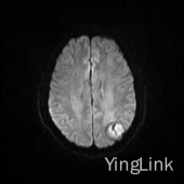 【病例】左顶部脑膜瘤1例MR影像表现 【病例】左顶部脑膜瘤1例MR影像表现
