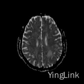 【病例】左顶部脑膜瘤1例MR影像表现 【病例】左顶部脑膜瘤1例MR影像表现