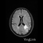 【病例】左顶部脑膜瘤1例MR影像表现 【病例】左顶部脑膜瘤1例MR影像表现