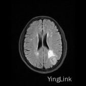 【病例】左顶部脑膜瘤1例MR影像表现 【病例】左顶部脑膜瘤1例MR影像表现