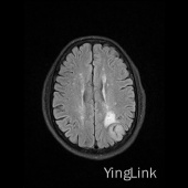 【病例】左顶部脑膜瘤1例MR影像表现 【病例】左顶部脑膜瘤1例MR影像表现