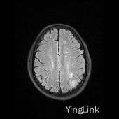 【病例】左顶部脑膜瘤1例MR影像表现 【病例】左顶部脑膜瘤1例MR影像表现