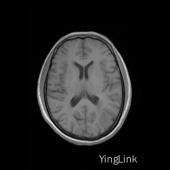 【病例】左顶部脑膜瘤1例MR影像表现 【病例】左顶部脑膜瘤1例MR影像表现