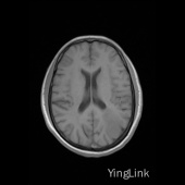 【病例】左顶部脑膜瘤1例MR影像表现 【病例】左顶部脑膜瘤1例MR影像表现
