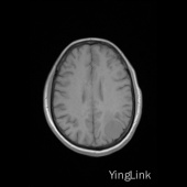 【病例】左顶部脑膜瘤1例MR影像表现 【病例】左顶部脑膜瘤1例MR影像表现