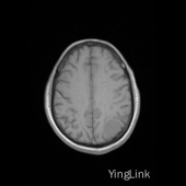【病例】左顶部脑膜瘤1例MR影像表现 【病例】左顶部脑膜瘤1例MR影像表现