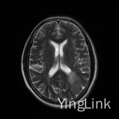 【病例】左顶部脑膜瘤1例MR影像表现 【病例】左顶部脑膜瘤1例MR影像表现