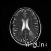 【病例】左顶部脑膜瘤1例MR影像表现 【病例】左顶部脑膜瘤1例MR影像表现