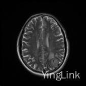 【病例】左顶部脑膜瘤1例MR影像表现 【病例】左顶部脑膜瘤1例MR影像表现