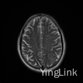 【病例】左顶部脑膜瘤1例MR影像表现 【病例】左顶部脑膜瘤1例MR影像表现