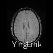 【病例】左顶部脑膜瘤1例MR影像表现 【病例】左顶部脑膜瘤1例MR影像表现