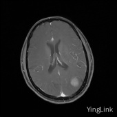 【病例】左顶部脑膜瘤1例MR影像表现 【病例】左顶部脑膜瘤1例MR影像表现
